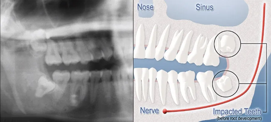 A diagram half mouth X-ray with teeth impaction and half digital graphic highlighting impacted teeth
