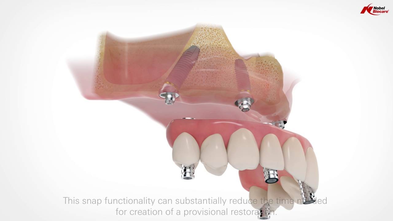 All-on-4 Treatment Concept Nobel Biocare Video Thumbnail